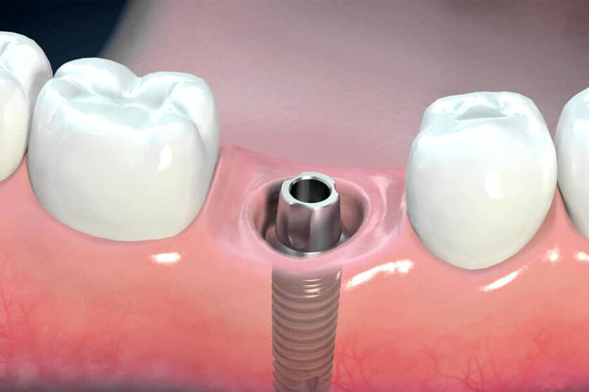 Trồng răng implant bắt vít có nhiều ưu điểm nổi bật hơn trồng răng implant xi măng