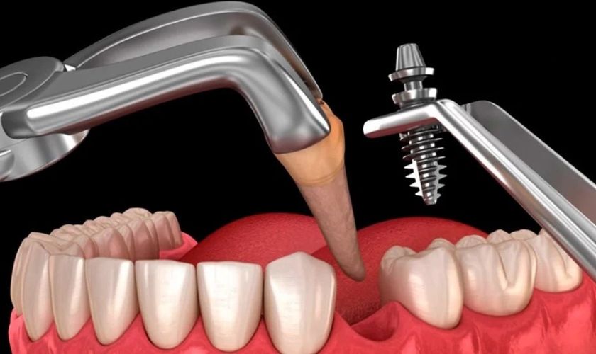 Trụ Implant Anthogyr phù hợp cho tất cả các loại xương khác nhau