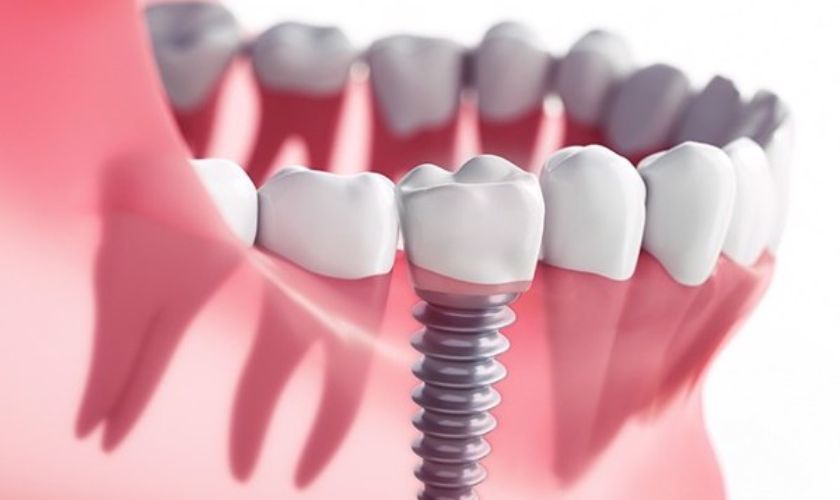 Nếu xương hàm thấp hoặc trung bình thì thời gian cấy ghép Implant kéo dài 3-6 tháng