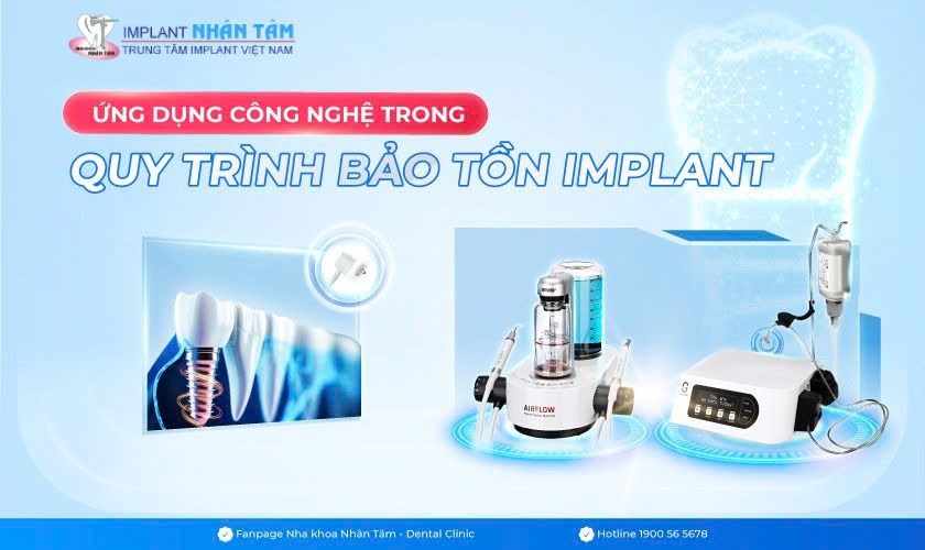 Ứng dụng công nghệ trong quy trình bảo tồn Implant