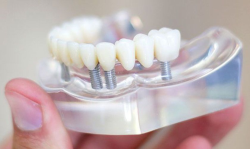 Quy trình cấy ghép Implant ứng dụng nha khoa kỹ thuật số