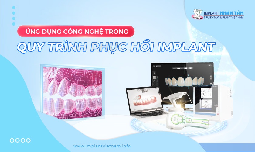 Ứng dụng công nghệ trong quy trình phục hồi răng Implant