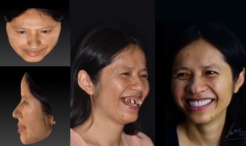 Facial Scan 3D giúp mô phỏng nụ cười khách hàng sau khi điều trị