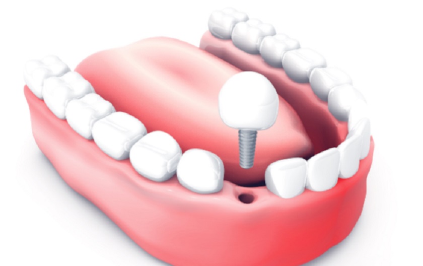 Nên niềng răng trước sau đó phục hình răng mất bằng cấy ghép Implant