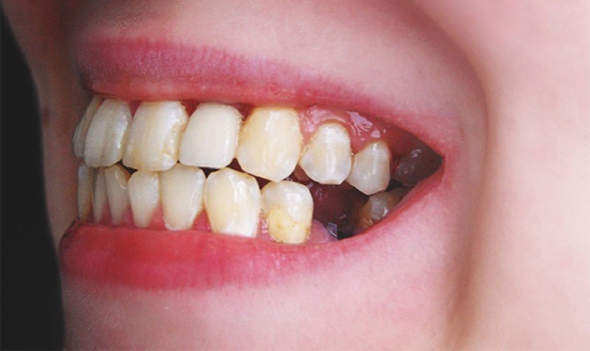 Giúp bạn giải đáp: Bị mất răng có niềng răng được không?