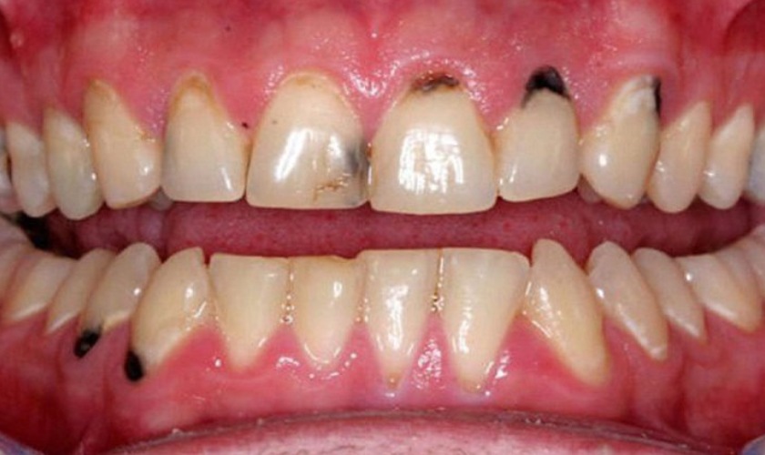 Sâu răng gây ra tình trạng chấm đen xuất hiện ở răng