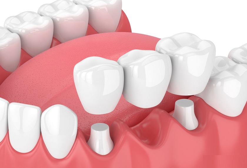Cầu răng sứ sử dụng các răng liền kề răng đã mất để làm trụ, Bác sĩ mài ít nhất là 2 chiếc răng bên cạnh và gắn một cầu răng bằng sứ để thay thế những răng bị mất Cầu răng sứ sử dụng các răng liền kề răng đã mất để làm trụ, Bác sĩ mài ít nhất là 2 chiếc răng bên cạnh và gắn một cầu răng bằng sứ để thay thế những răng bị mất