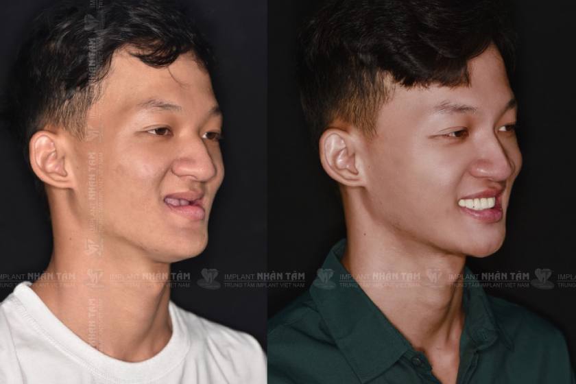 Khách hàng không răng bẩm sinh trước và sau khi cấy ghép Implant tại Trung tâm Implant Việt Nam Khách hàng không răng bẩm sinh trước và sau khi cấy ghép Implant tại Trung tâm Implant Việt Nam