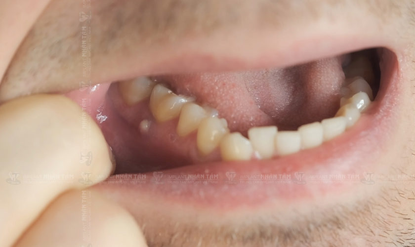 Đau răng do bệnh lý không thể tự hết mà cần được điều trị nha khoa