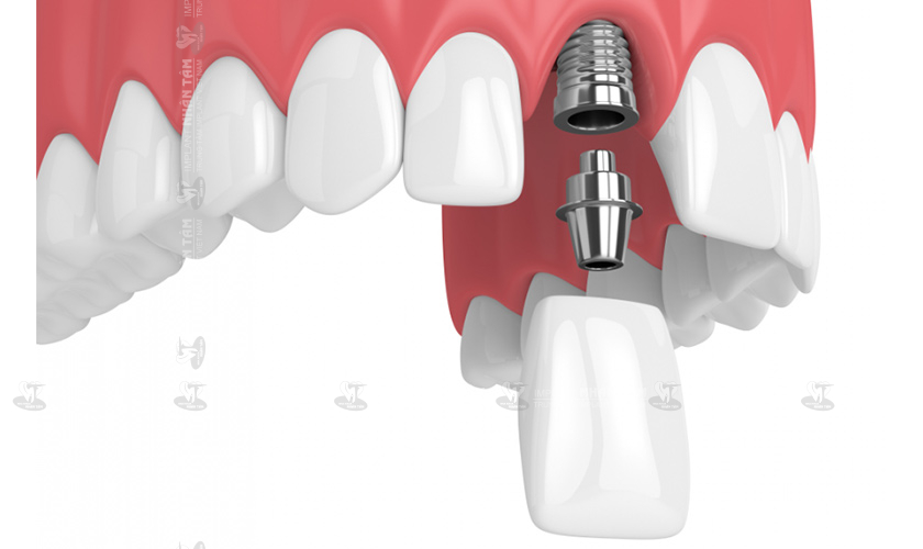 Trồng răng Implant là giải pháp tối ưu khi bị mất 1 răng cửa