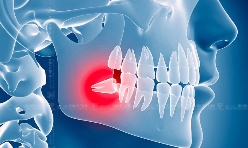 Cách giảm đau răng khi mọc răng khôn