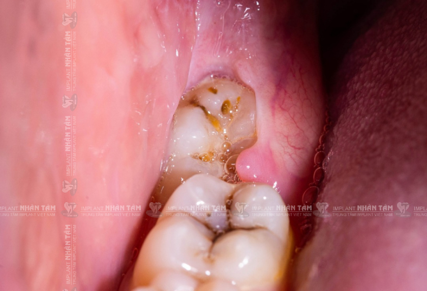 Răng khôn mọc vào độ tuổi trưởng thành nên dễ mọc kẹt dưới nướu và gây đau