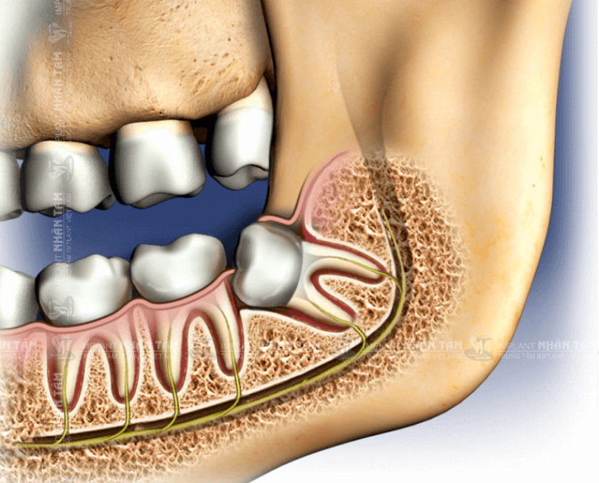 Răng khôn mọc “dại” làm tăng nguy cơ nhiễm trùng và biến chứng