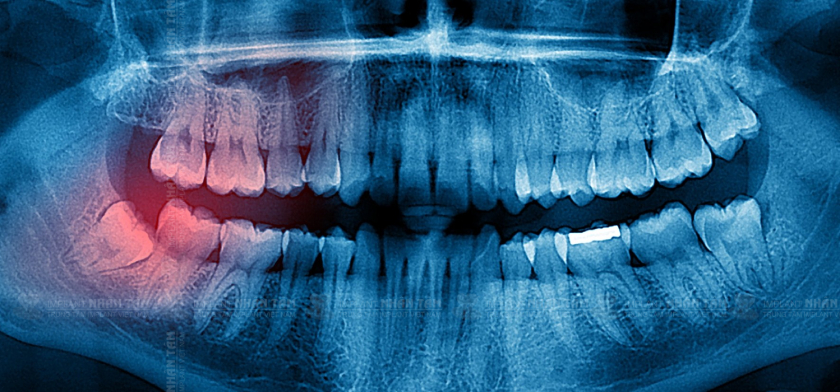 Răng khôn thường hay mọc lệch, mọc kẹt dưới nướu gây đau và tiềm ẩn nhiều biến chứng