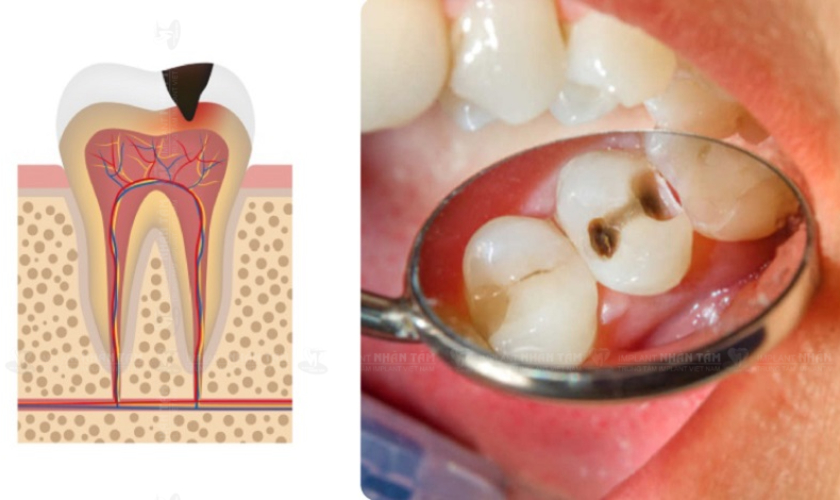 Sâu răng là vấn đề răng miệng thường gặp ở phụ nữ mang thai