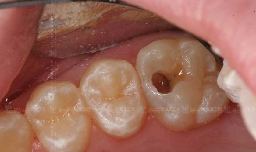 Lỗ sâu răng gây đau răng