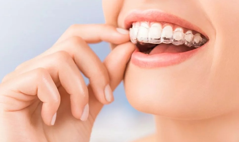 Niềng răng vô hình Invisalign