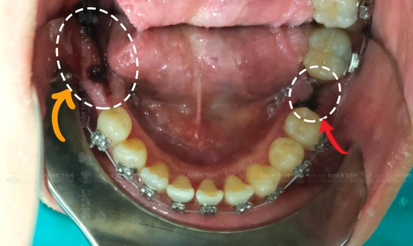 Mất răng hàm có thể niềng răng nếu tình trạng của bệnh nhân phù hợp