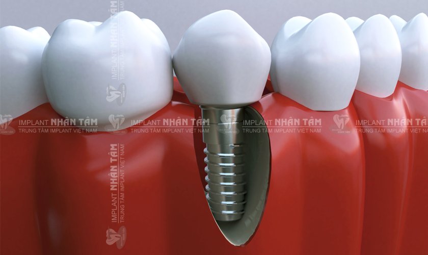 Cấy ghép răng Implant là giải pháp trồng răng giả tối ưu nhất hiện nay khi muốn điều trị mất răng