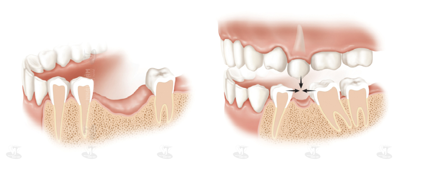 Bị tiêu xương hàm do mất răng