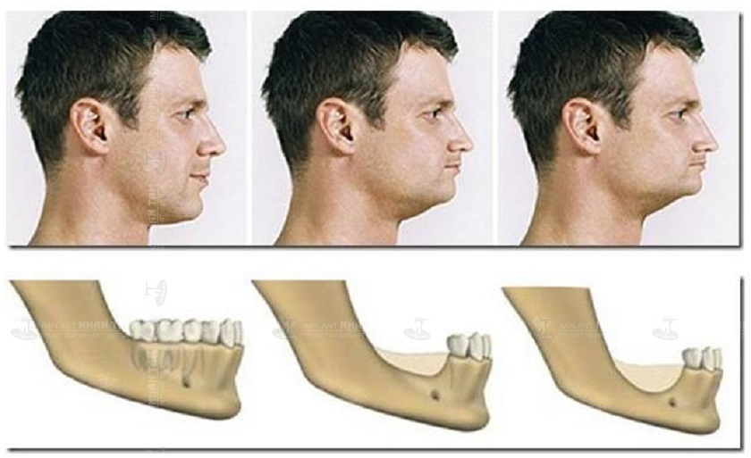 Tiêu xương hàm, mặt biến dạng do mất răng lâu năm