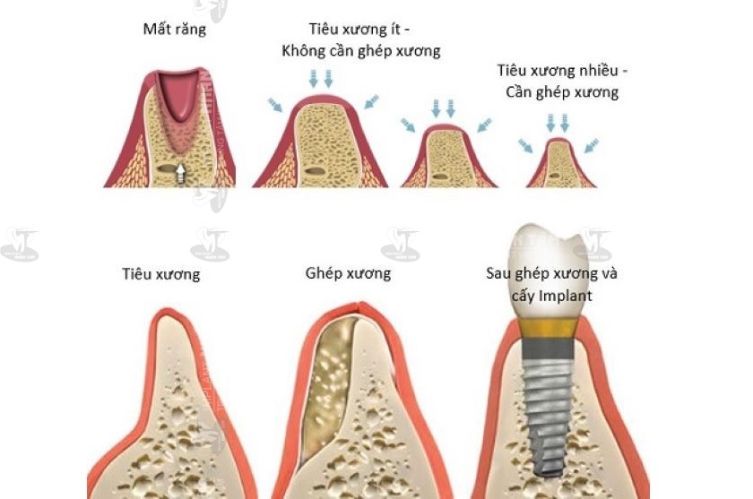 Cấy ghép răng Implant giúp phục hồi chức năng ăn nhai, thẩm mỹ và ngăn ngừa tiêu xương hàm