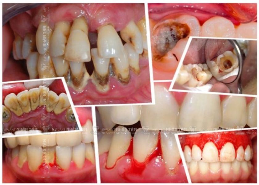 Tùy theo nguyên nhân và mức độ tổn thương răng mà Bác sĩ sẽ lên phác đồ điều trị phù hợp