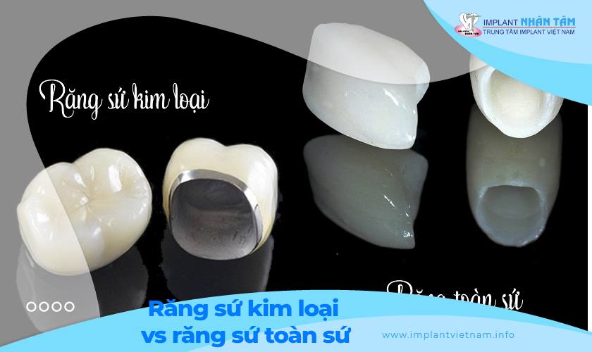 Răng sứ kim loại và răng sứ toàn sứ khác nhau như thế nào?