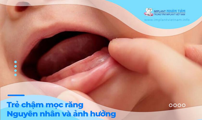 Trẻ chậm mọc răng do đâu? Có ảnh hưởng như nào đến trẻ?