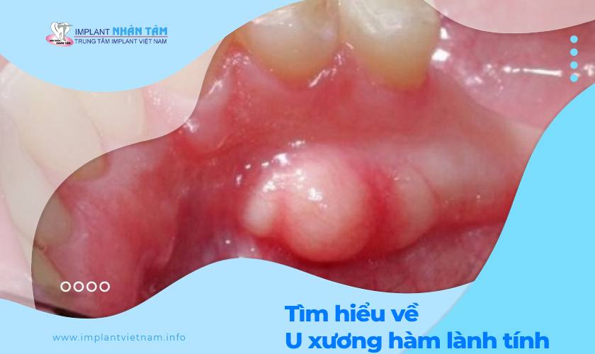 U xương hàm lành tính – Nguyên nhân và cách điều trị