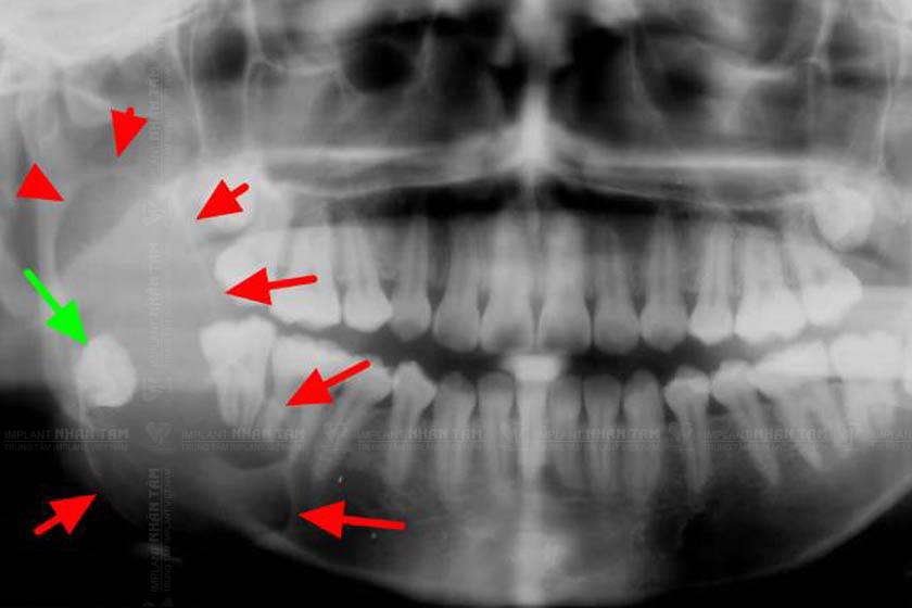 Răng khôn mọc ngầm có thể gây ra những khối u hàm