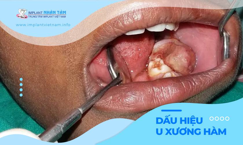 U xương hàm răng - Dấu hiệu và cách điều trị