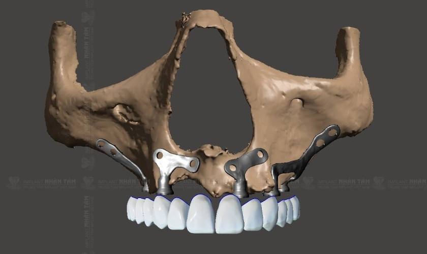 Cấy ghép Implant cá nhân hóa được áp dụng cho bệnh nhân phẫu thuật cắt bỏ đoạn xương hàm