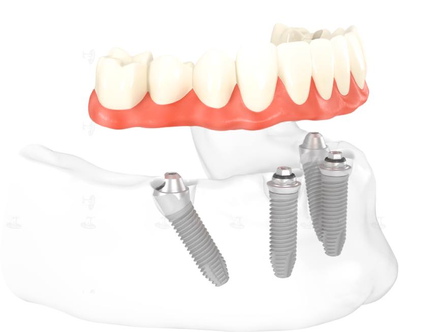 Việc kiểm soát nhiễm khuẩn, nhiễm trùng vô cùng quan trọng trong phục hình Implant tức thì toàn hàm