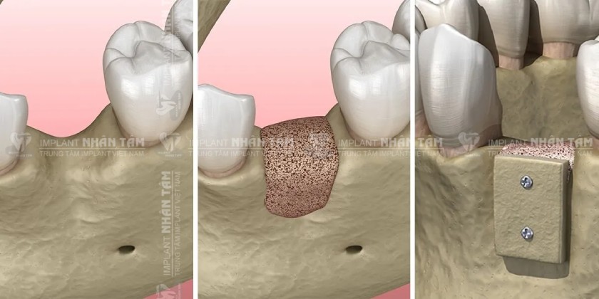 Nhổ răng lâu năm vẫn có thể trồng Implant được nhưng có thể cần ghép xương
