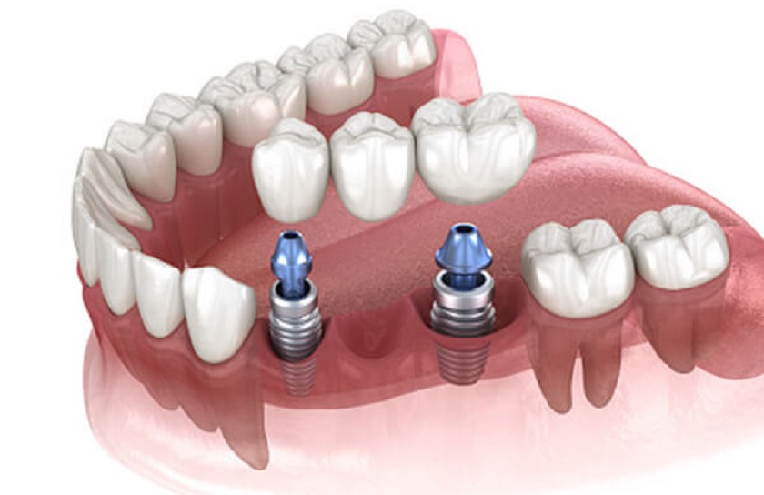 Chỉ cần cấy 2 trụ Implant trong trường hợp mất 3, 4 răng cạnh nhau