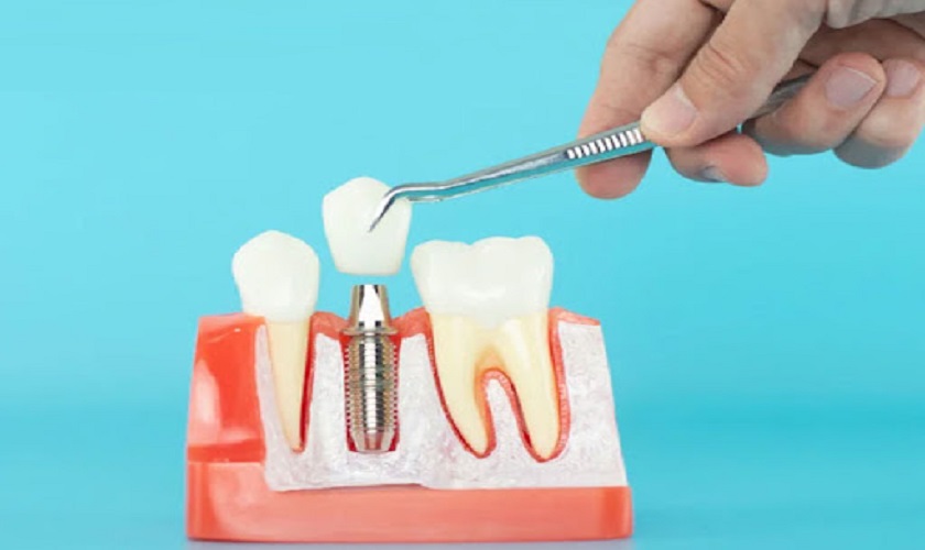 Những sự thật trồng răng Implant mà các nha sĩ ngại nói với bạn