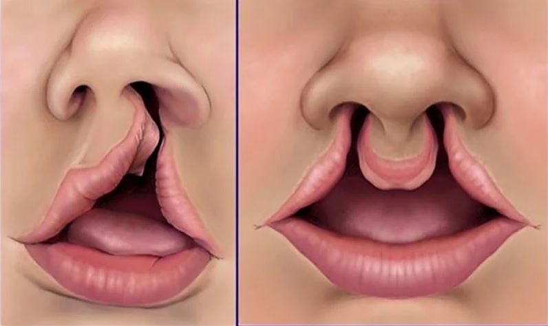 Tình trạng khe hở môi vòm miệng