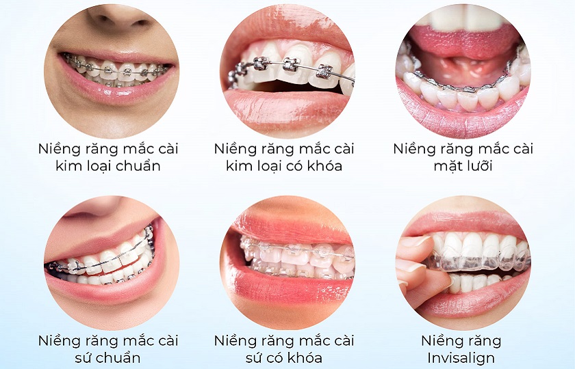 Phương pháp niềng răng với các loại khí cụ khác nhau