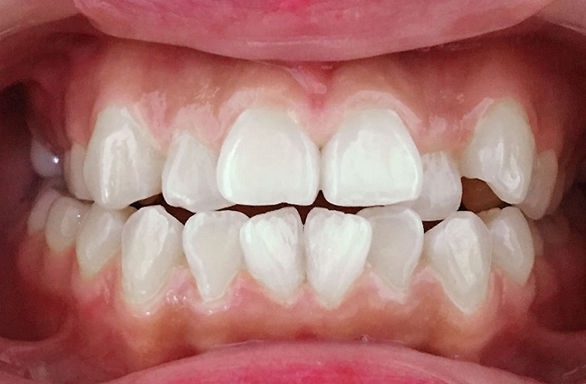 Niềng răng Invisalign thường được chỉ định cho các trường hợp sai lệch răng nhẹ