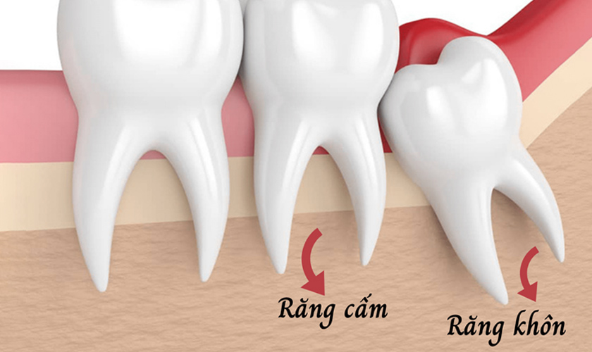 Phân biệt răng cấm và răng khôn