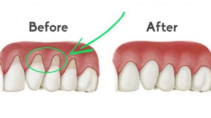 Ghép nướu giúp chân răng được che phủ đầy đủ, không bị lộ ra ngoài