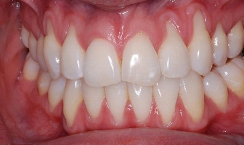 Tình trạng chân răng bị lộ ra ngoài gây mất thẩm mỹ và ê buốt răng