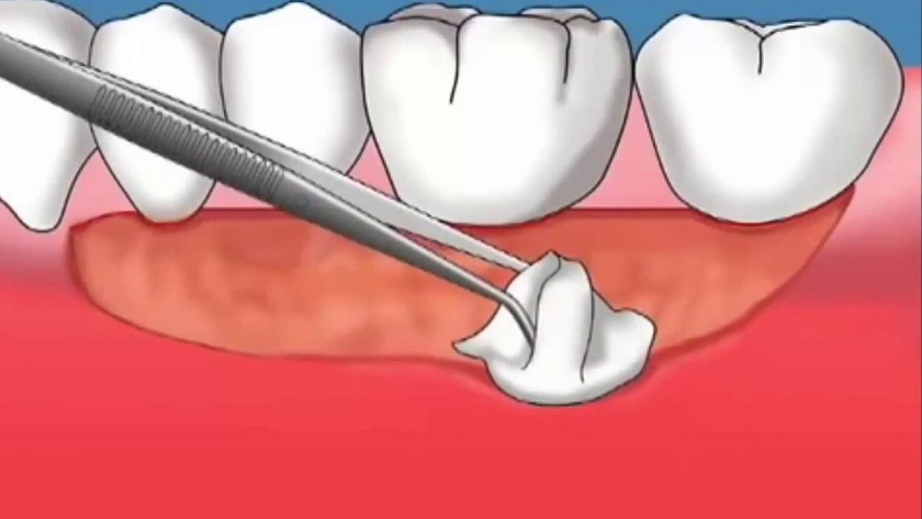 Ghép nướu răng có đau không?