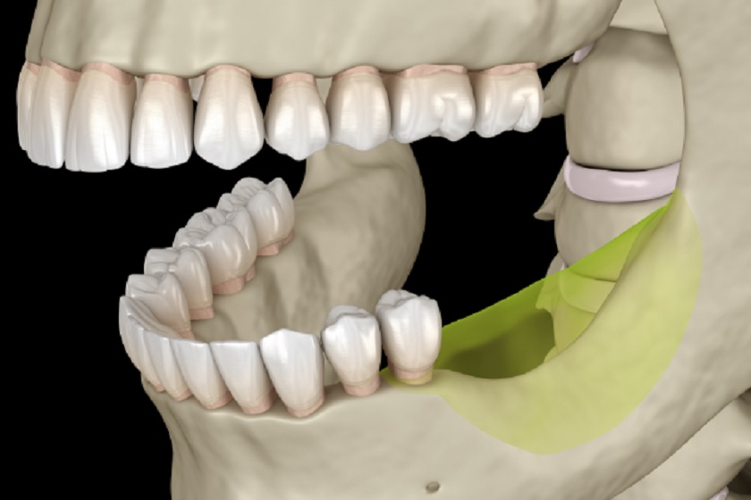 Người có xương hàm không đủ thể tích theo tiêu chuẩn cần ghép xương trước khi cắm Implant