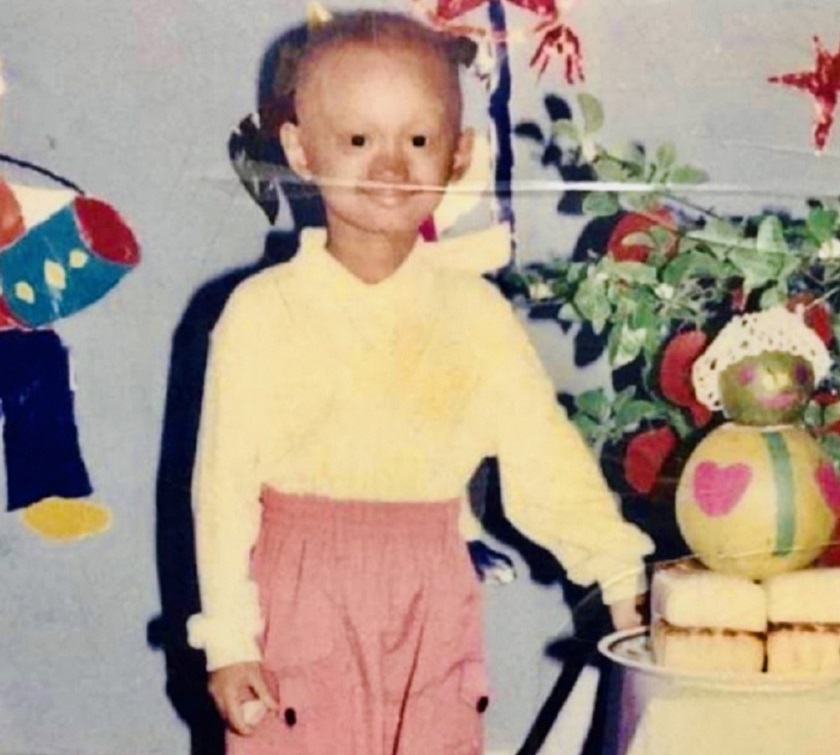 Hình ảnh Nguyễn Ngọc Hạnh khi lên 5 với khuôn miệng không răng và mái đầu không tóc do chứng loạn sản ngoại bì