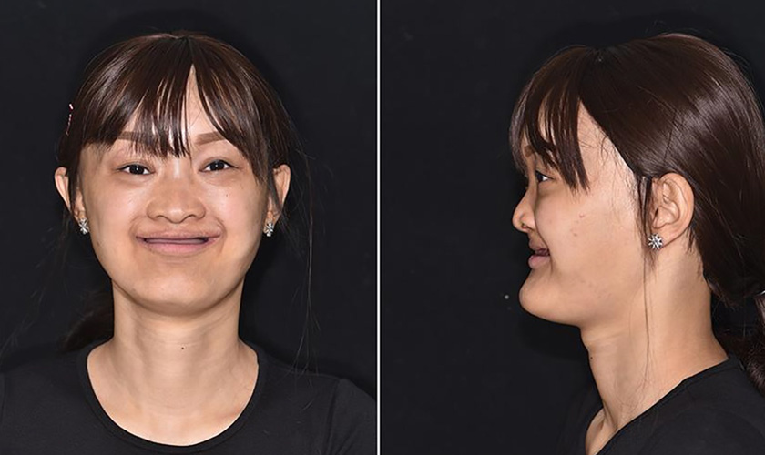 Tình trạng của Nguyễn Ngọc Hạnh khi trưởng thành với chứng không răng bẩm sinh