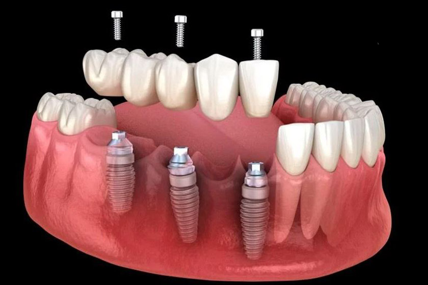 Giải pháp phục hình răng Implant nối liền