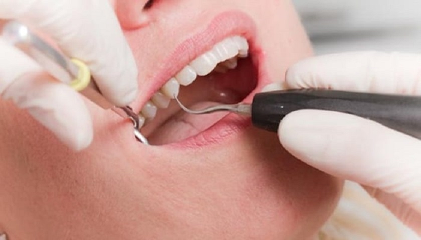 Nên khám răng và cạo vôi răng định kì để duy trì răng miệng khỏe mạnh