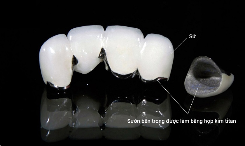 Sản phẩm răng sứ kim loại truyền thống với khung sườn được làm từ hợp kim